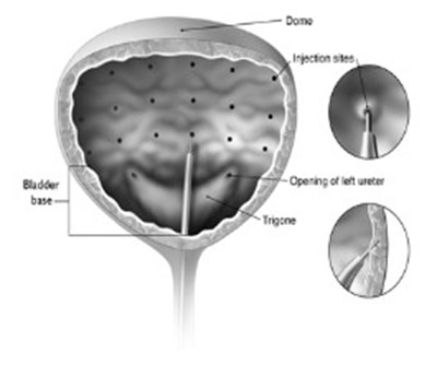 Figure 1:	Injection Pattern For Intradetrusor Injections For Treatment Of Overactive Bladder And Detrusor Overactivity Associated With A Neurologic Condition (Botox 01)