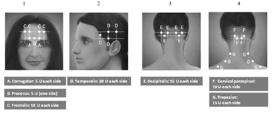 Diagrams 1-4: Recommended Injection Sites (a Through G) For Chronic Migraine (Botox 02)