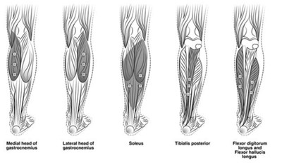 Figure 3: Injection Sites For Adult Lower Limb Spasticity (Botox 04)