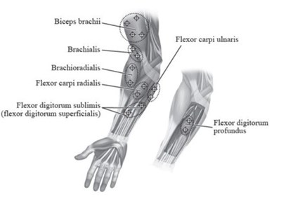 Figure 4: Injection Sites For Pediatric Upper Limb Spasticity (Botox 05)