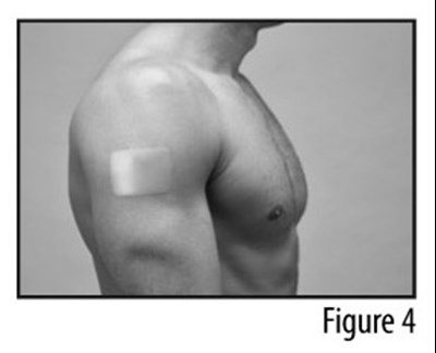 Figure 4 (Patch applied to shoulder)