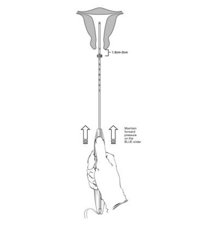 Figure 9:  Move Liletta Into The Fundal Position (Liletta Shi 0a)