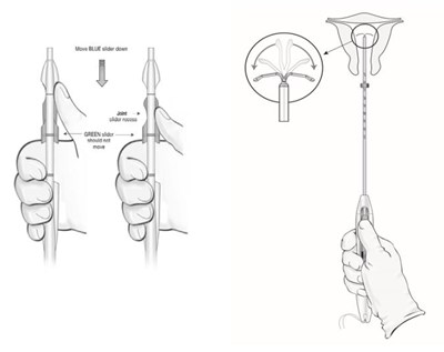 Figure 10:  Releasing Liletta From The Inserter Tube (Liletta Shi 0b)