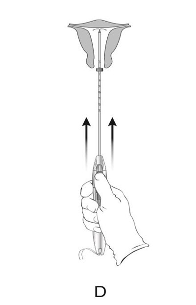 Figure 11:  Green Indicator Visible And Threads Released From Cleft (Liletta Shi 0c)