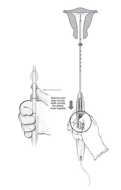 Figure 12:  Cut The Threads About 3 Cm From The Cervix (Liletta Shi 0d)