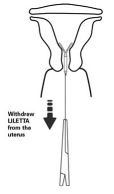 Figure 14: Diagram Of Liletta (Liletta Shi 10)