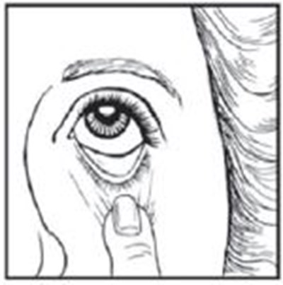 5 - timolol maleate ophthalmic gel forming solution 8