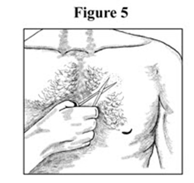 Applying A Fentanyl Transdermal System Figure 5 (1d03fd3c Ae7c 4605 92eb 263f9e78ad9e 06)