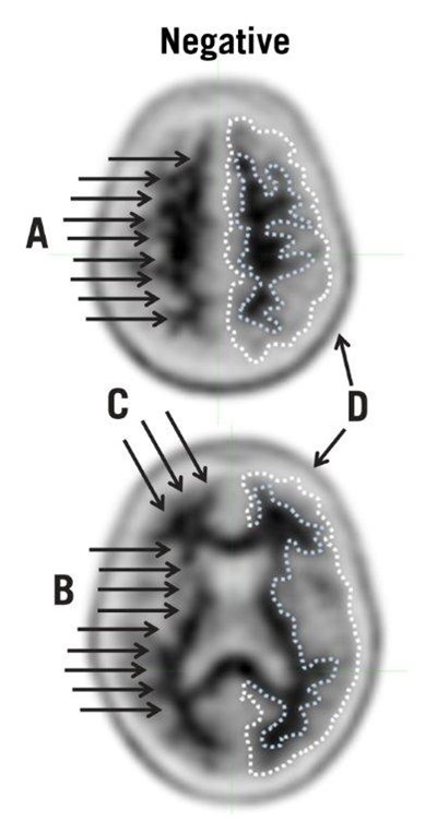 Figure 2 (Amyvid Pet Image 2)