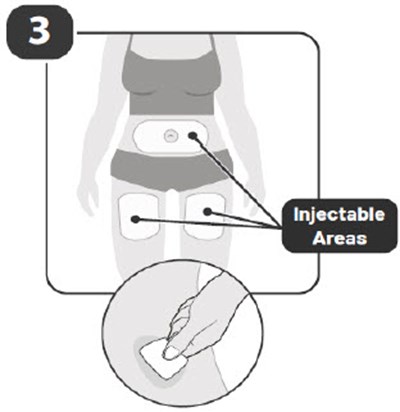 Image Of Injectable Areas (instructions for use)
