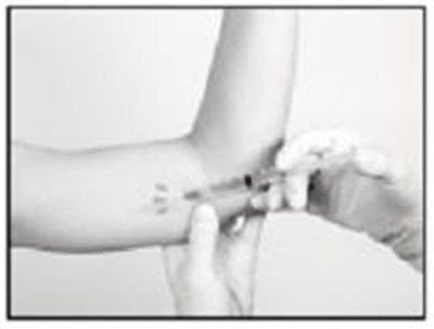 Removal: Anesthetic (Supprelin La 12)