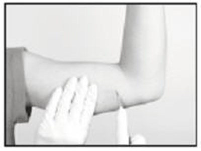 Making The Incision And Removing The Implant (Supprelin La 13)