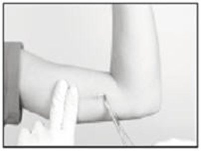 supprelin-la-14.jpg Gently but securely grasp the implant with the sterile mosquito clamp and extract the implant - supprelin la 14