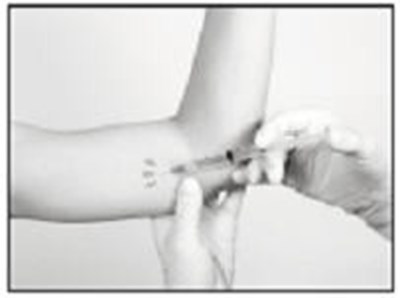 Insertion: Anesthetic (Supprelin La 3)