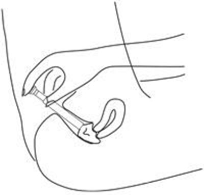 5d5728bc-figure-05 - metronidazole vaginal gel 5