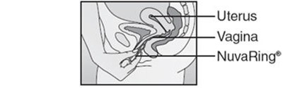 Figure F (Nuvaring 08)