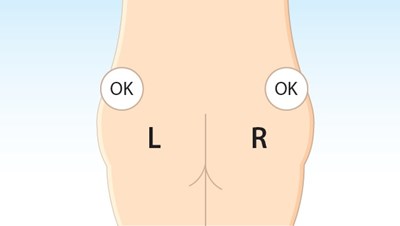 1 (Lanreotide Injection Matoda 13)