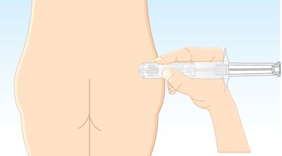 1 (Lanreotide Injection Matoda 19)