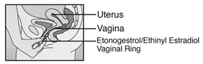 etonogestrel-12.jpg Figure F - etonogestrel 12