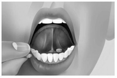 Tablet Placement (Buprenorphine And Naloxone Sublingual Tablets 3)