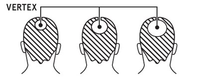 Minoxidil Vertex 1